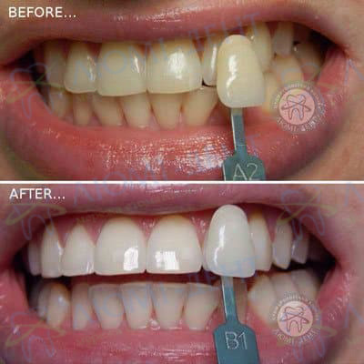 Відбілювання зубів magic Smile
